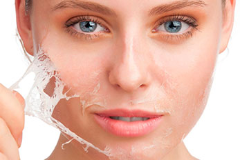 cauterização química