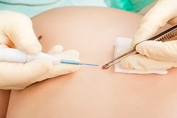 eletrocauterização