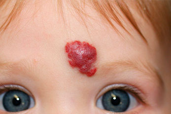 hemangioma