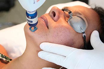 laser de erbium fracionado