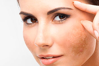 melasma