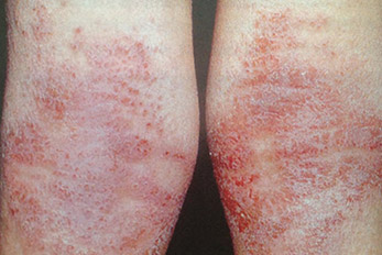 dermatite-atopica