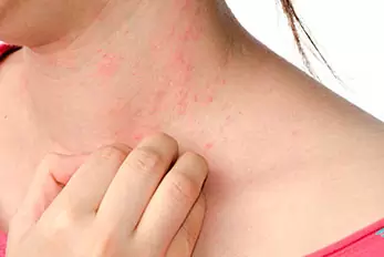 alergia na pele