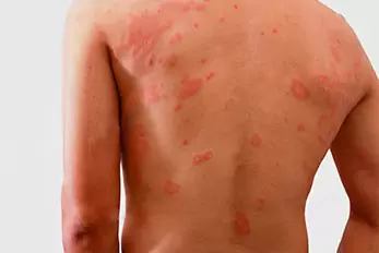 hanseníase