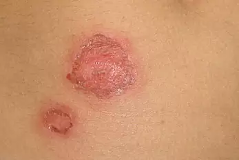 impetigo