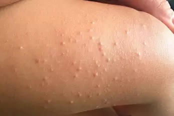 molusco contagioso