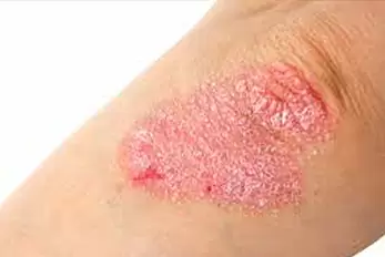 psoríase