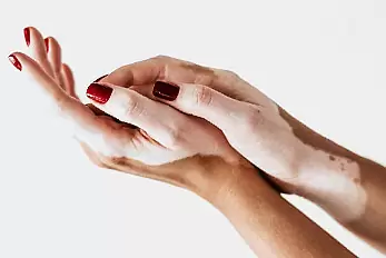 vitiligo