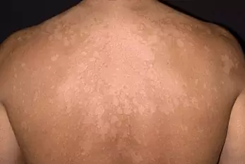 micose
