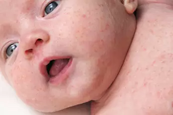 miliaria